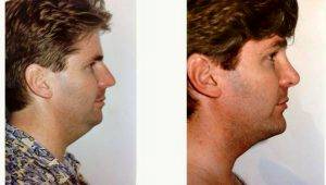 32 Year Old Man Treated With Facelift With Doctor Boris M. Ackerman, MD, Newport Beach Plastic Surgeon