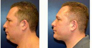 36 Year Old Man Treated With Facelift By Dr Richard G. Reish, MD, New York Plastic Surgeon