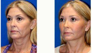 37 Year Old Woman Treated With Facelift By Dr Amir M. Karam, MD, San Diego Facial Plastic Surgeon
