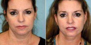 37 Year Old Woman Treated With Facelift By Dr Sean T. Lille, MD, Scottsdale Plastic Surgeon