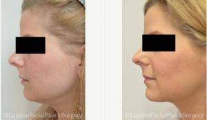 40 Year Old Woman Treated With Facelift Before And After With Doctor Julian De Silva, MD, London Oculoplastic Surgeon