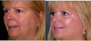 41 Year Old Woman Treated With Facelift With Dr Frank Isik, MD, Seattle Plastic Surgeon