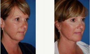42 Year Old Woman Treated With Facelift By Dr. William Portuese, MD, Seattle Facial Plastic Surgeon