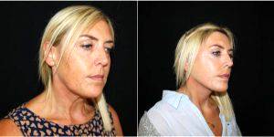 45 Year Old Woman Treated With Facelift Before And After By Dr Amir Nakhdjevani, MBBS, MRCS, FRCS (Plast), London Plastic Surgeon