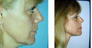 45 Year Old Woman Treated With Facelift Before And After By Dr. Malcolm A. Lesavoy, MD, Beverly Hills Plastic Surgeon