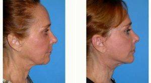 45 Year Old Woman Treated With Facelift By Dr. George Sanders, MD, Los Angeles Plastic Surgeon