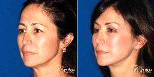 45 Year Old Woman Treated With Facelift With Dr. Joseph Thomas Cruise, MD, Newport Beach Plastic Surgeon