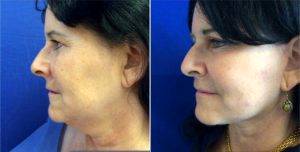 46 Year Old Woman Treated With Facelift By Dr Ahmed Maki, DO, Los Angeles Facial Plastic Surgeon