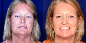 46 Year Old Woman Treated With Facelift With Doctor Stephen J. Ronan, MD, FACS, San Francisco Plastic Surgeon