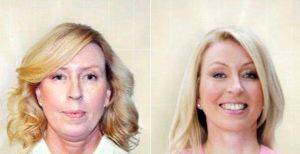 47 Year Old Woman Treated With Facelift Before And After By Dr Michael Zacharia, MBBS, Sydney Facial Plastic Surgeon