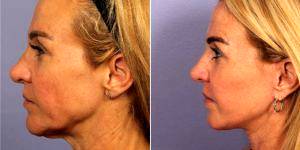 47 Year Old Woman Treated With Facelift By Doctor Grant Stevens, MD, Los Angeles Plastic Surgeon