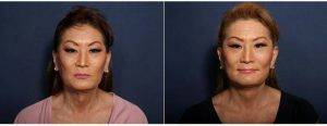 47 Year Old Woman Treated With Facelift (view 1 Of 2) By Dr Johan E. Brahme, MD, San Diego Plastic Surgeon