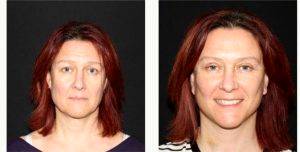48 Year Old Woman Treated With Facelift Before And After With Doctor Amir Nakhdjevani, MBBS, MRCS, FRCS (Plast), London Plastic Surgeon