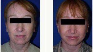 48 Year Old Woman Treated With Facelift By Dr Carlos Mata, MD, MBA, FACS, Scottsdale Plastic Surgeon