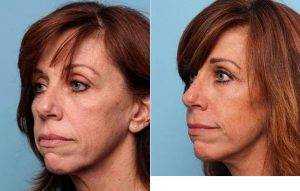 49 Year Old Woman Receives Facelift And Neck Lift By Dr. Justin West, MD, Newport Beach Plastic Surgeon