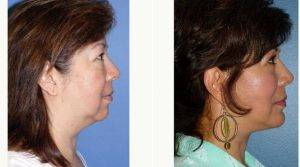 49 Year Old Woman Treated With Facelift Before And After With Doctor Andrew P. Ordon, MD, Beverly Hills Plastic Surgeon