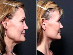 49 Year Old Woman Treated With Facelift By Dr Remus Repta, MD, Scottsdale Plastic Surgeon
