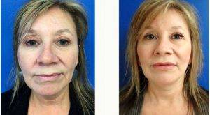 49 Year Old Woman Treated With Facelift By Dr. Ross Blagg, MD, Austin Physician