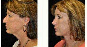50 Year Old Woman Treated With Facelift By Dr. Gary Motykie, MD, Los Angeles Plastic Surgeon