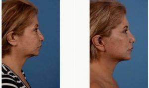 51 Year Old Woman After Facelift, Neck Lift, Upper And Lower Blepharoplasty, And Chin Implant Before With Dr. David A. Sieber, MD, San Francisco General Surgeon
