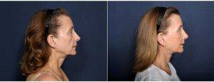 51 Year Old Woman Treated With Neck Lift (view 2 Of 2) By Dr. H. Michael Roark, MD, San Diego Plastic Surgeon