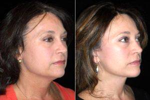 52 Year Old Wanted Facial Rejuvenation With Dr. Lisa Lynn Sowder, MD, Seattle Plastic Surgeon