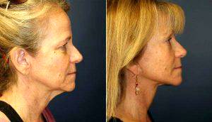 52 Year Old With Premature Aging By Doctor Steve Laverson, MD, San Diego Plastic Surgeon