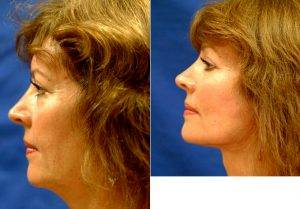 52 Year Old Woman Treated With Facelift By Doctor Juris Bunkis, MD, FACS, Newport Beach Plastic Surgeon
