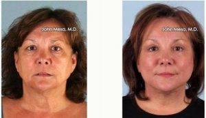 52 Year Old Woman Treated With Facelift, Neck Lift, Biplanar Endoscopic Brow Lift Eyelids Lift By Dr John Mesa, MD, New York Plastic Surgeon