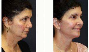 52 Year Old Woman Treated With Facelift With Dr. Kris M. Reddy, MD, FACS, West Palm Beach Plastic Surgeon
