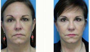 53 Year Old Woman Treated With Facelift With Dr. Michael A. Epstein, MD, FACS, Chicago Plastic Surgeon