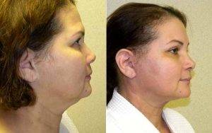 54 Year Old HIspanic Patient Who Underwent Facelift And Browlift By Doctor Eric T. Emerson, MD, FACS, Charlotte Plastic Surgeon
