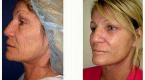 54 Year Old Woman Treated With Facelift Before And After By Dr. Andrew T. Cohen, MD, Beverly Hills Plastic Surgeon