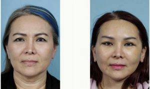 54 Year Old Woman Treated With Facelift With Dr. John Y.S. Kim, MD, FACS, Chicago Plastic Surgeon