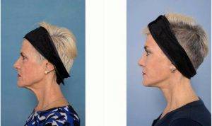 55 Year Old Woman Treated With Facelift By Dr Howard Webster, MBBS (Hons), FRACS, Melbourne Plastic Surgeon