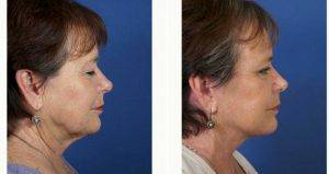 55 Year Old Woman Treated With Facelift By Dr. John M. Hilinski, MD, San Diego Facial Plastic Surgeon
