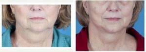 56 Year Old Woman Treated With Facelift Before And After With Doctor Kenneth Yu, MD, San Antonio Facial Plastic Surgeon