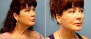 56 Year Old Woman Treated With Facelift By Dr Leonard Lu, MD, Chicago Plastic Surgeon