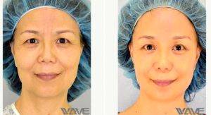 56 Year Old Woman Treated With Facelift By Dr Peter Lee, MD, FACS, Los Angeles Plastic Surgeon