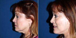 56 Year Old Woman Treated With Facelift By Dr. M. Sean Freeman, MD, Charlotte Facial Plastic Surgeon