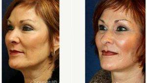 56 Year Old Woman Treated With Facelift With Doctor Amir M. Karam, MD, San Diego Facial Plastic Surgeon
