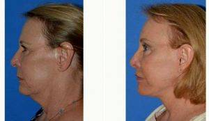 56 Year Old Woman Treated With Facelift With Doctor James M. Pearson, MD, Los Angeles Facial Plastic Surgeon