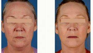 56 Year Old Woman Treated With Facelift With Doctor Jason Roostaeian, MD, Los Angeles Plastic Surgeon
