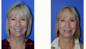 57 Year Old Woman Treated With Facelift And Fat Transfer With Dr. Walton Montegut, MD, Newport Beach Physician