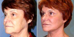57 Year Old Woman Treated With Facelift Before And After With Dr. Ritu Chopra, MD, Beverly Hills Plastic Surgeon