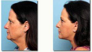 57 Year Old Woman Treated With Facelift By Doctor Mark Gaon, MD - Newport Beach Plastic Surgeon
