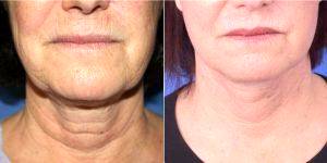 57 Year Old Woman Treated With Facelift By Dr. Glynn Bolitho, PhD, MD, FACS, San Diego Plastic Surgeon