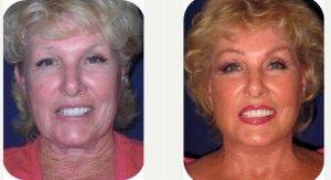 57 Year Old Woman Treated With Facelift By Dr. Stephen Fink, DO FAOCO, Newport Beach Facial Plastic Surgeon