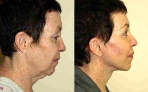 58 Year Old Female Treated For Sagging Of The Face And Neck By Dr. Robert M. Freund, MD, New York Plastic Surgeon