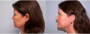 58 Year Old Woman Treated With Facelift And Necklift By Dr Amy T. Bandy, DO, FACS, Newport Beach Plastic Surgeon